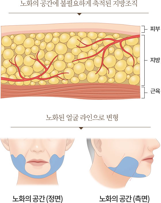 티타늄 SHR MODE & STACK MODE 3파장 레이저 리프팅 + 타이트닝 + 화이트닝 세가지 효과 / 써마지 THERMAGE 피부 속 콜라겐을 재생 주름개선 효과